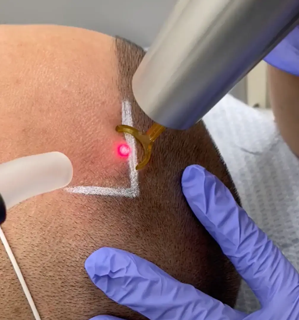 Remove Scalp Micropigmentation safely with the Picoway at Studio Kiku